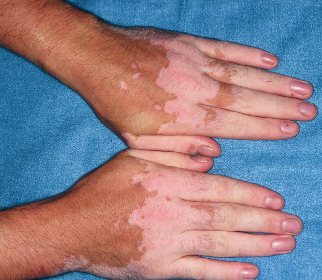Main vitiligo