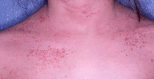Dermatite atopique