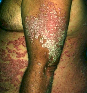 Psoriasis