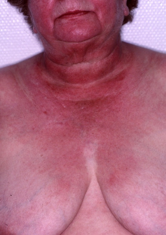 Dermatomyosite