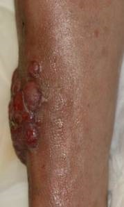 Lymphome cutané B diffus à grandes cellules type jambe