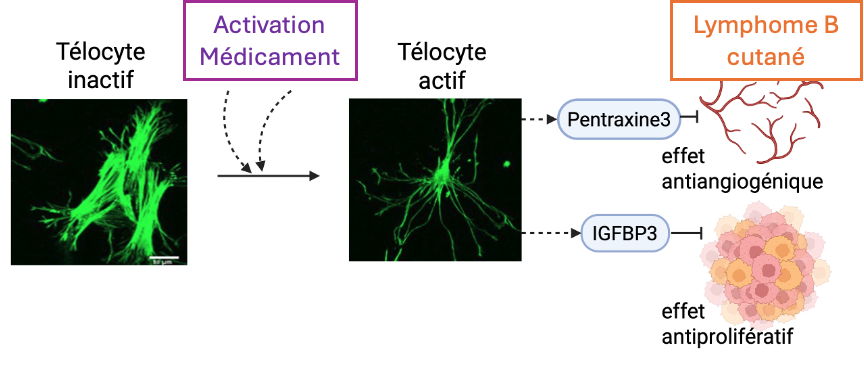 Lymphome cutané B diffus à grandes cellules type jambe