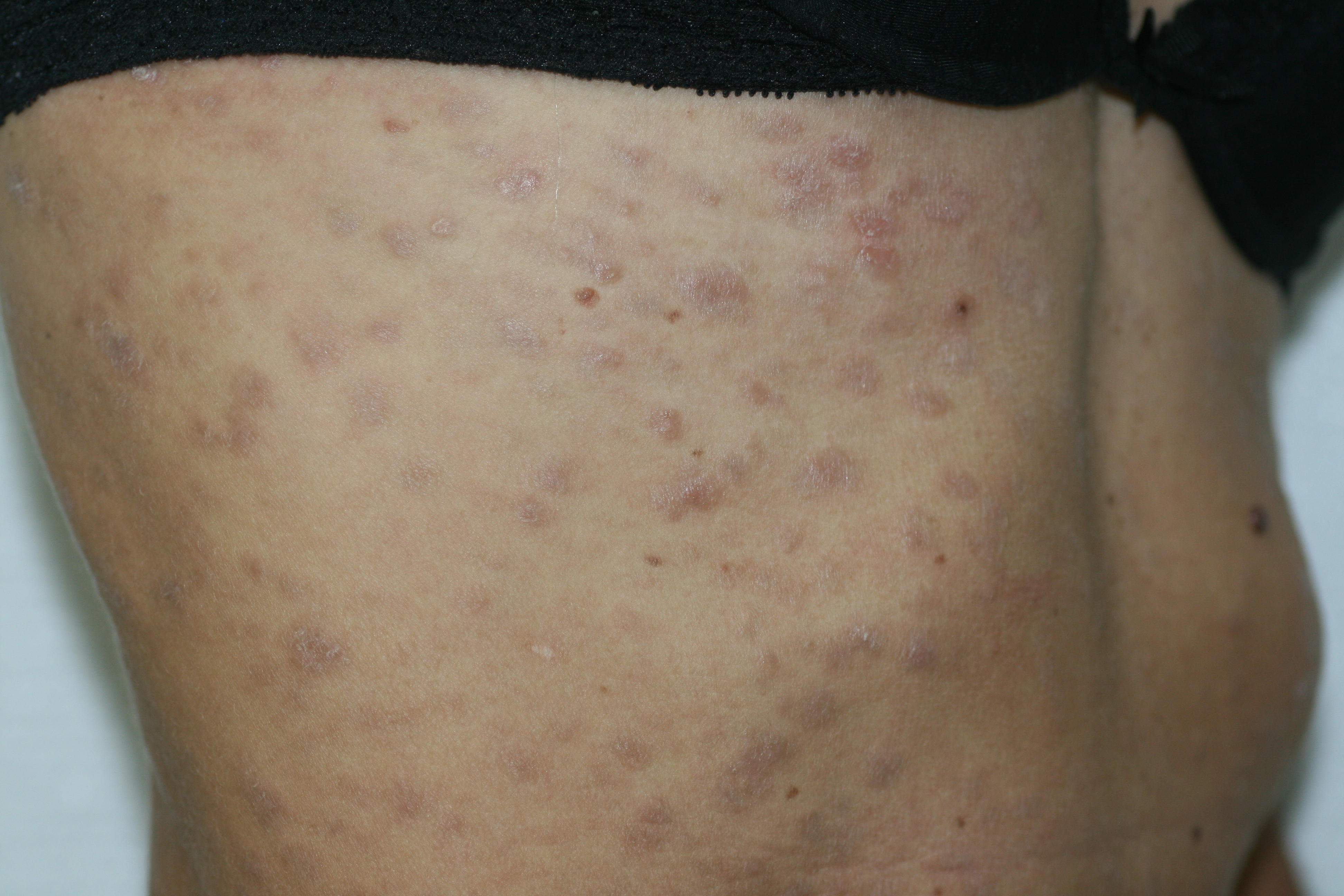 Syphilis