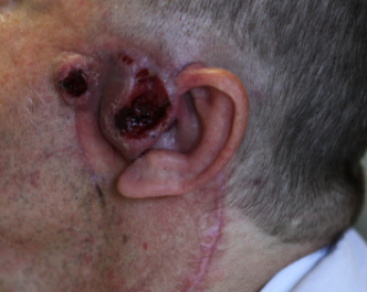 Syphilis