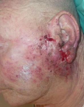 Syphilis