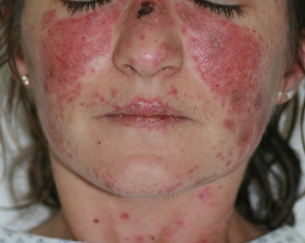 lupus cutané